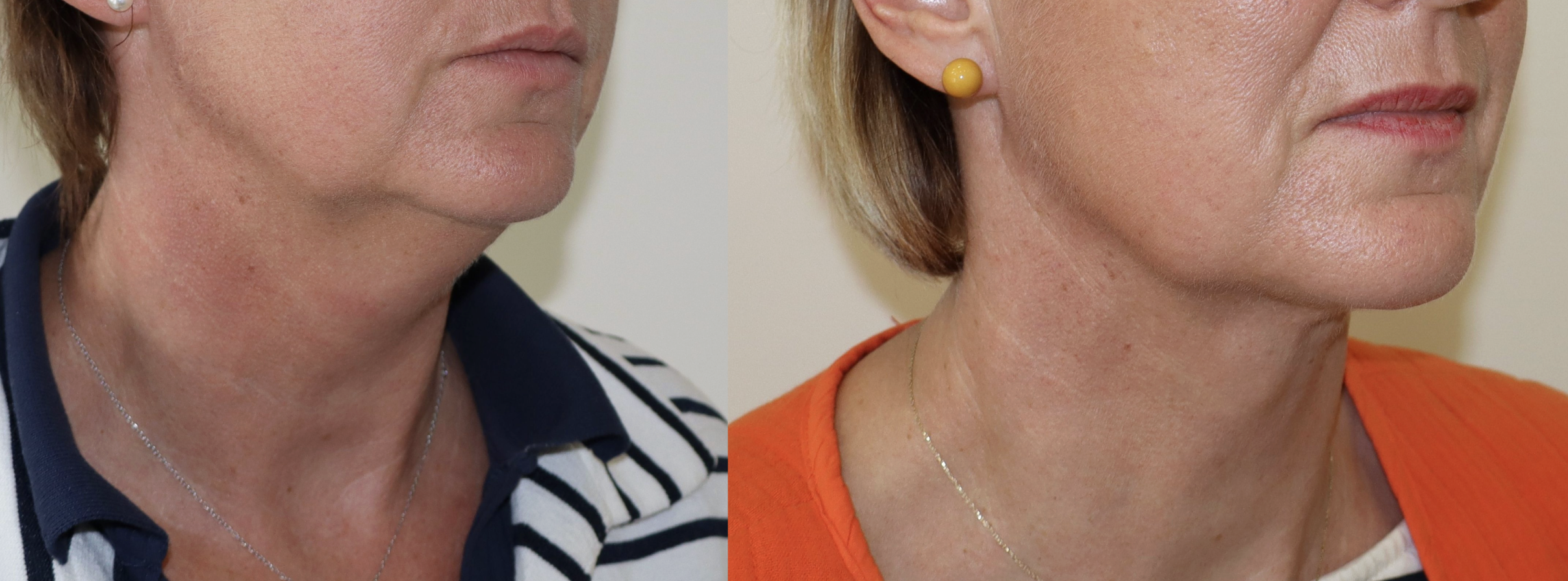 Avant/Après lipoaspiration cervicale